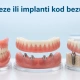 Proteze ili implanti kod bezubosti: kako izabrati rešenje recent post image