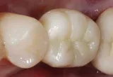 Rezultat tretmana — Ugradnja implantata