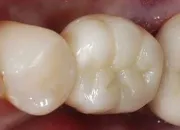 Rezultat tretmana — Ugradnja implantata